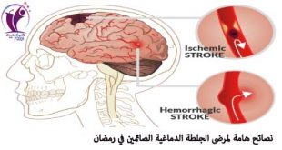 نصائح هامة لمرضى الجلطة الدماغية الصائمين في رمضان